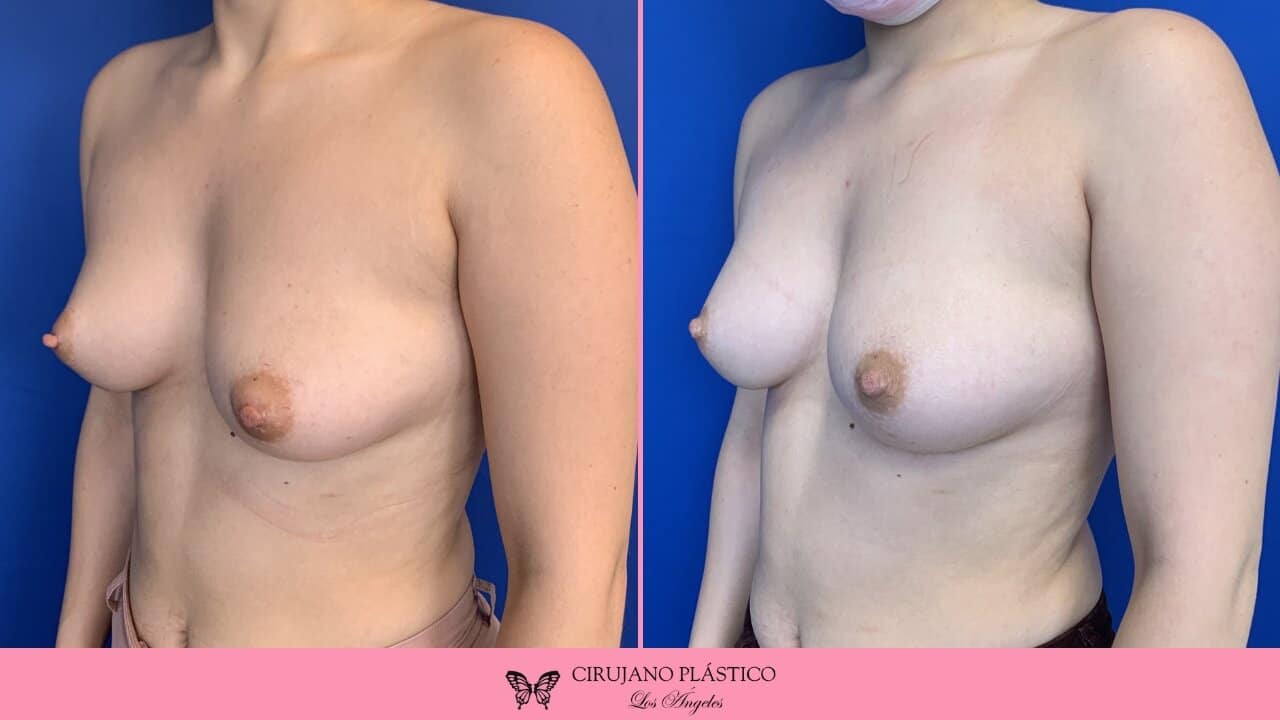 Nipple Sugery Before and After Patient 1b