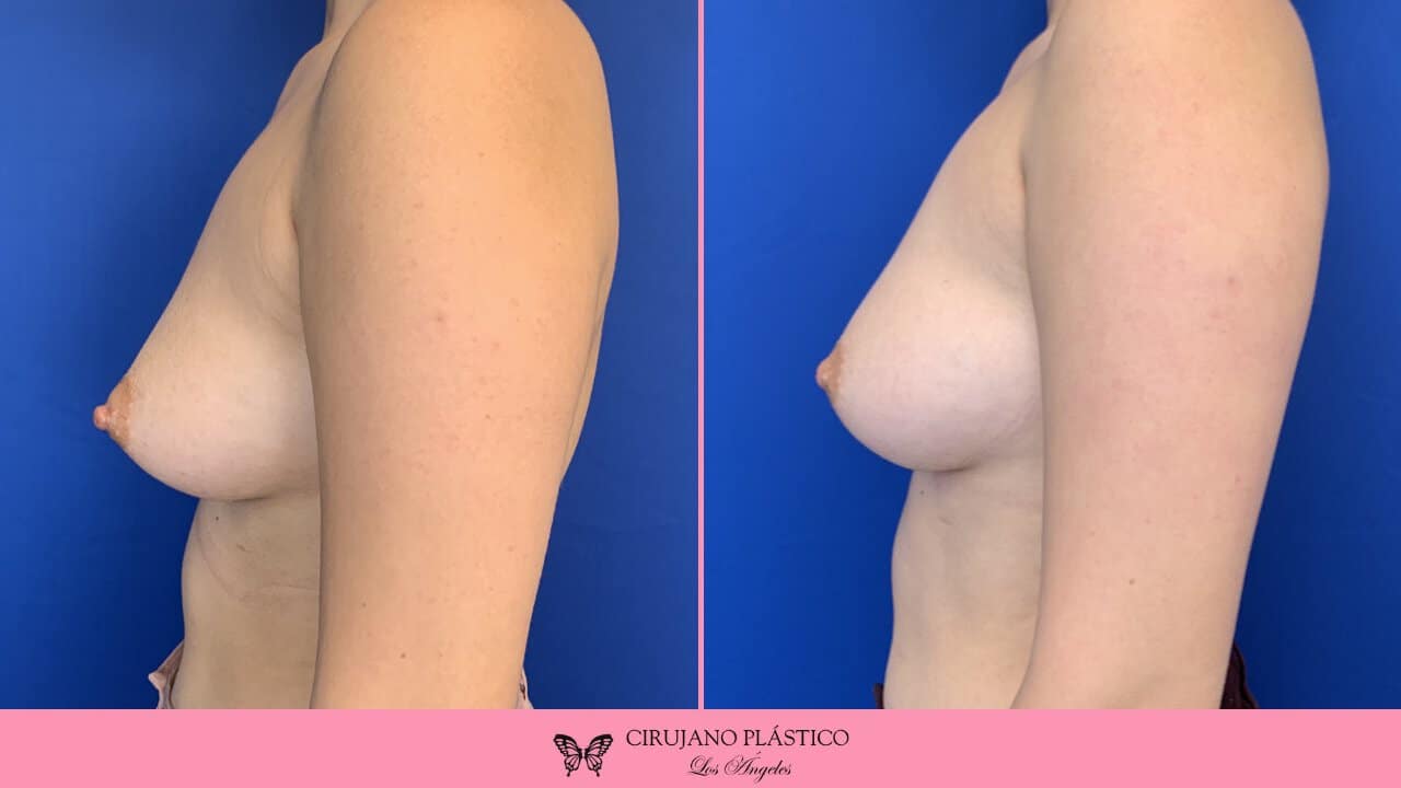 Nipple Sugery Before and After Patient 1c
