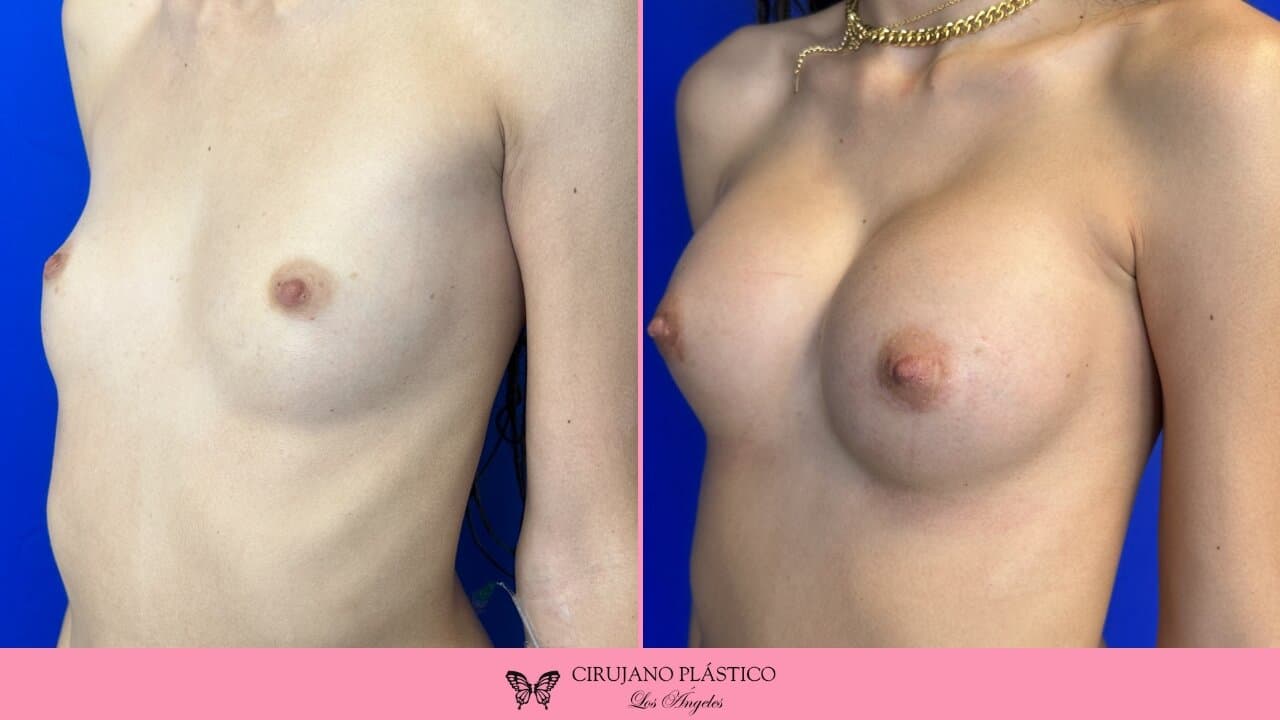 Nipple Sugery Before and After Patient 2b
