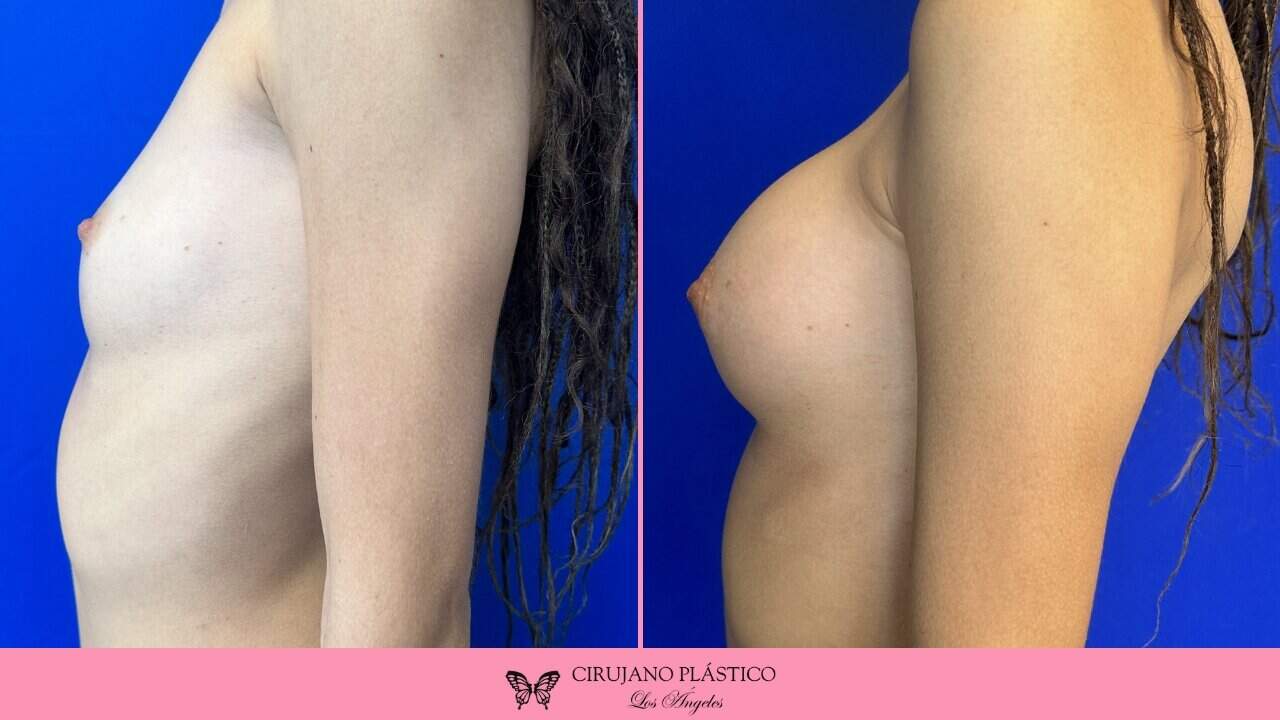 Nipple Sugery Before and After Patient 2c