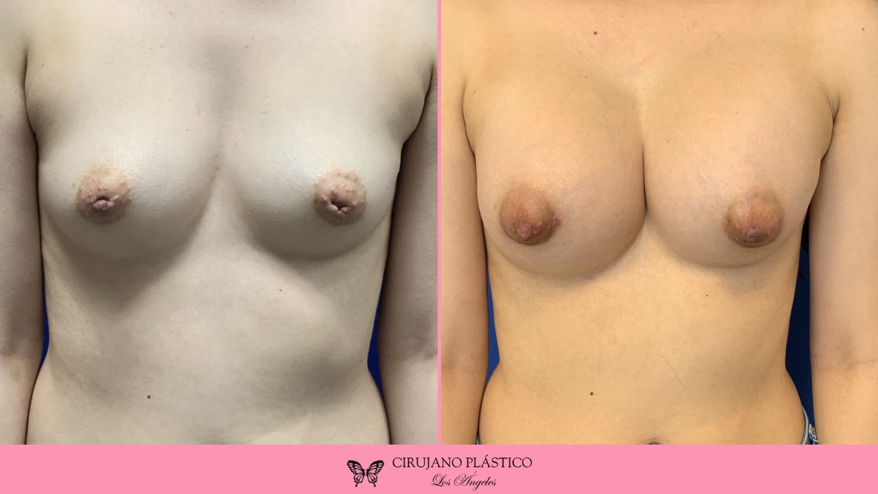 Nipple Sugery Before and After Patient 3a