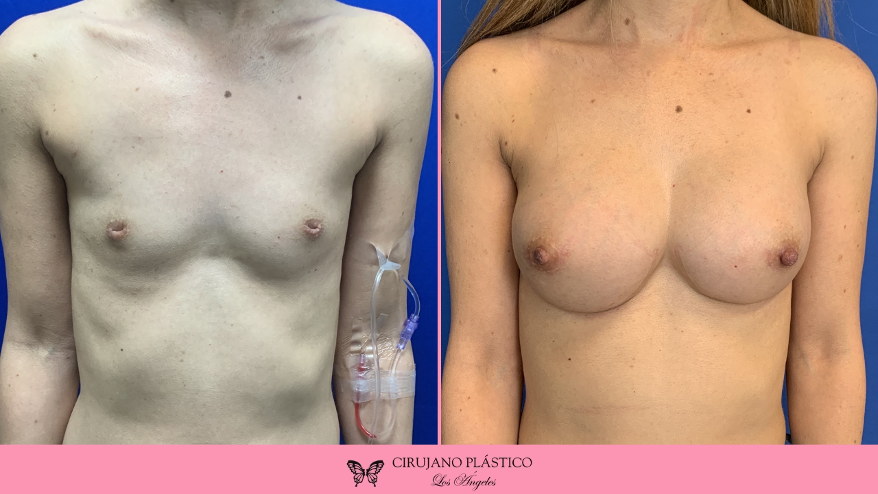 Nipple Sugery Before and After Patient 4a