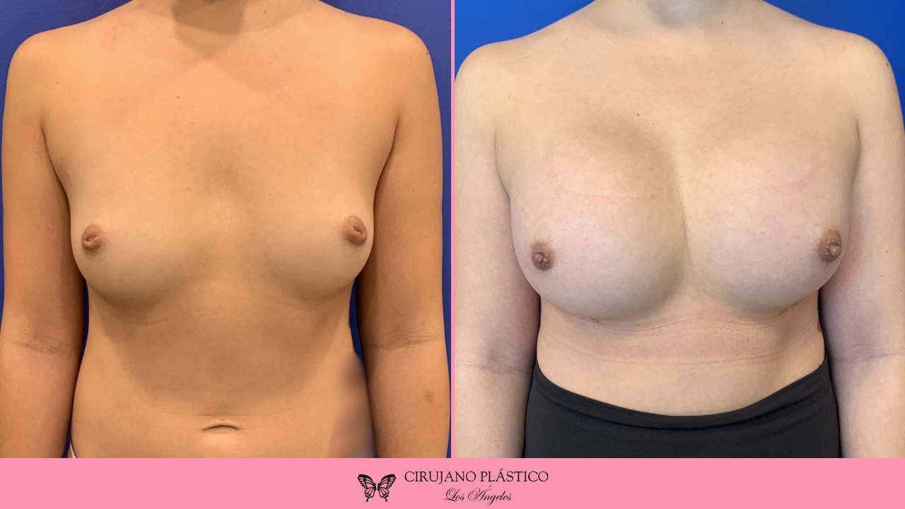 Nipple Sugery Before and After Patient 7a