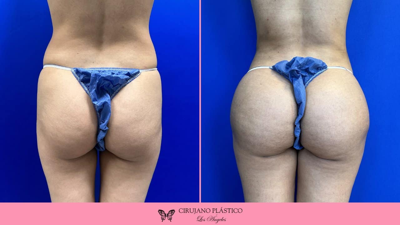 BBL Before and After Patient 1a