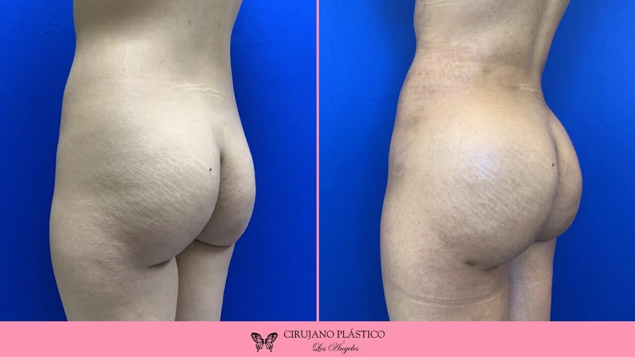 BBL Before and After Patient 2c