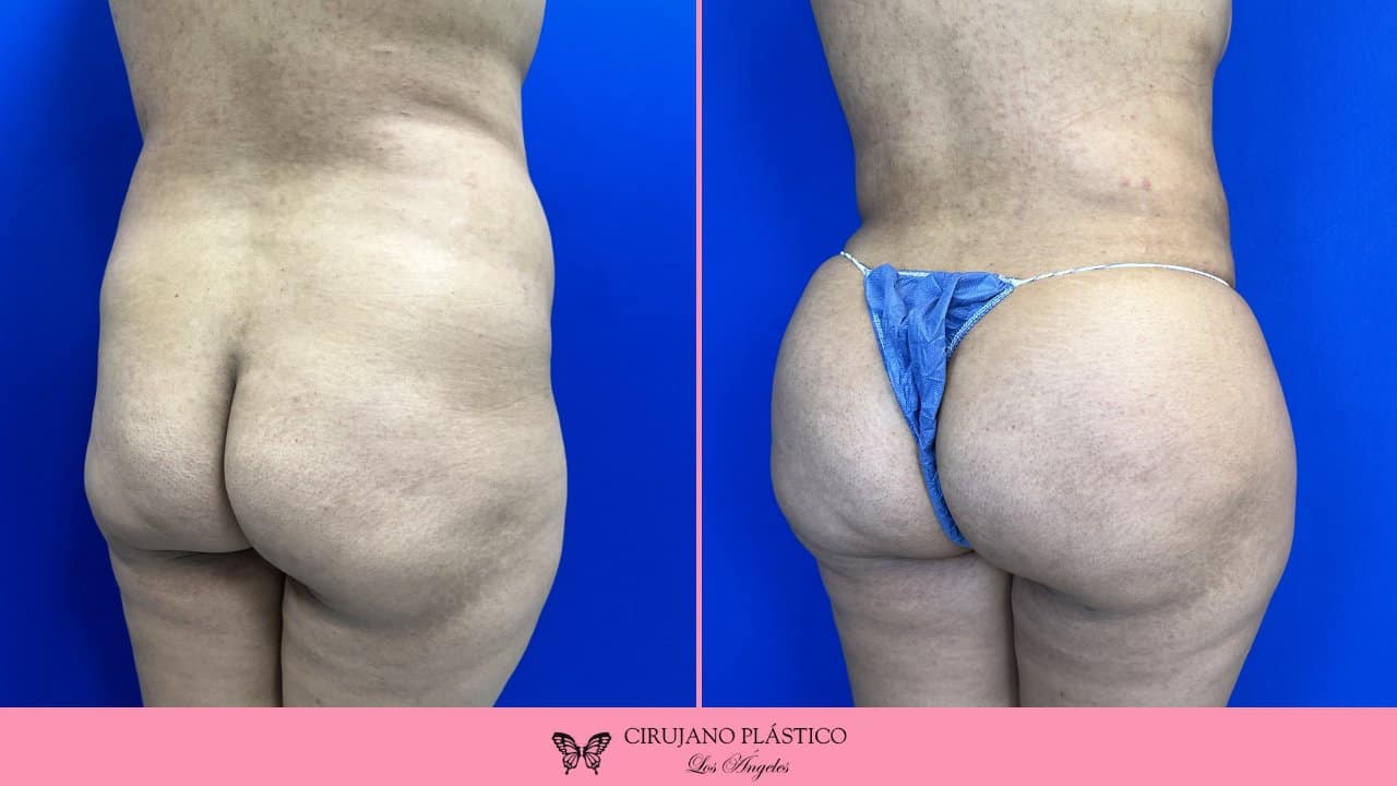 BBL Before and After Patient 3b