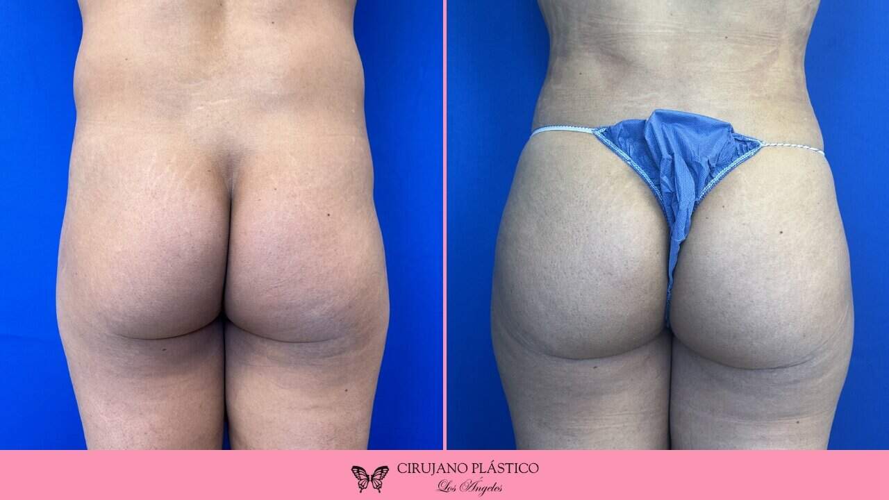 BBL Before and After Patient 4a