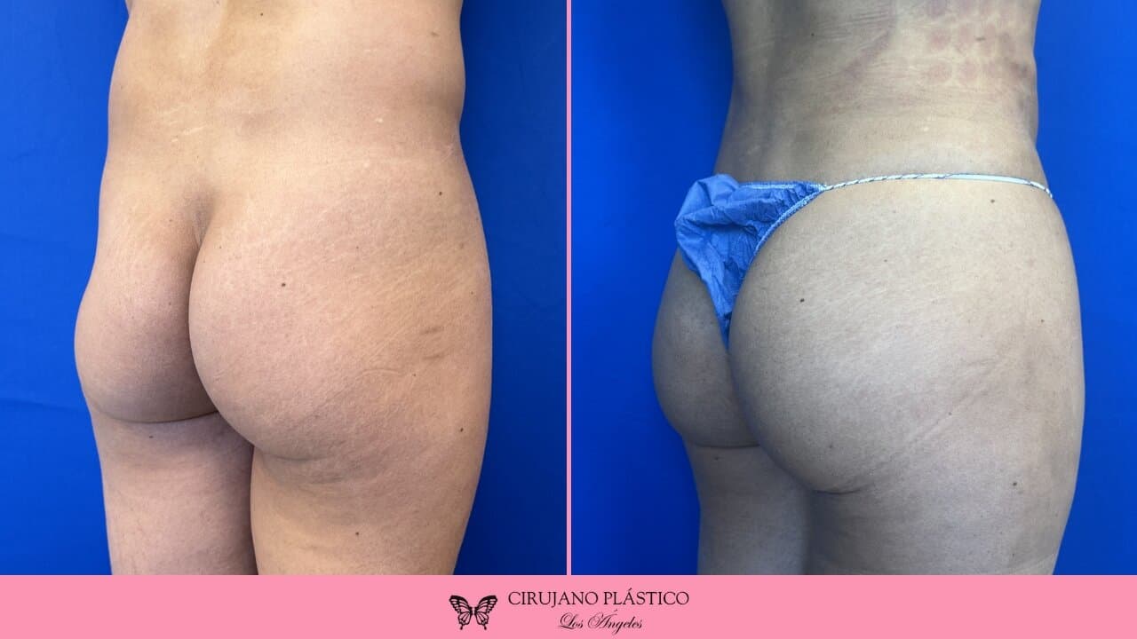 BBL Before and After Patient 4b