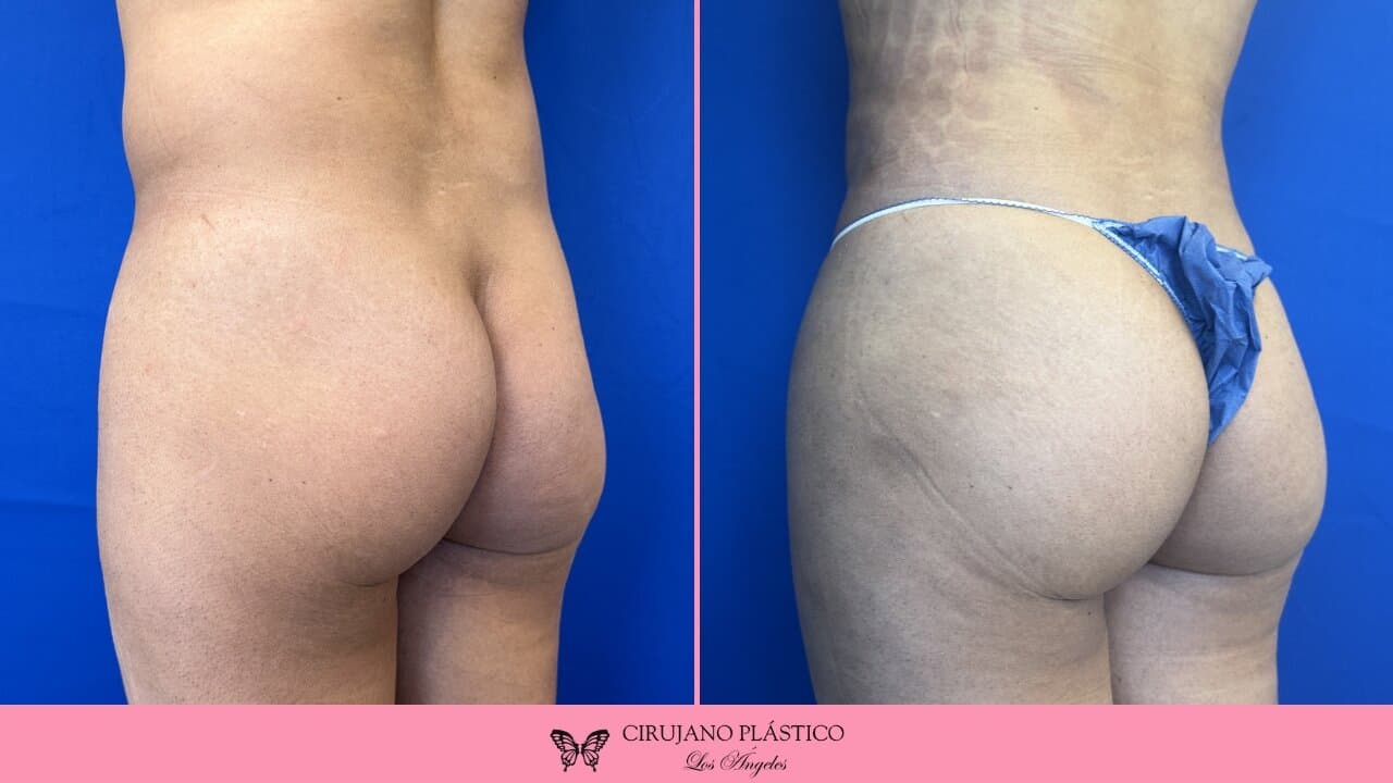 BBL Before and After Patient 4c