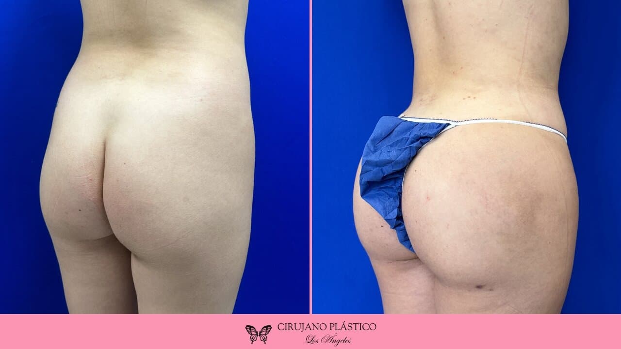 BBL Before and After Patient 5b