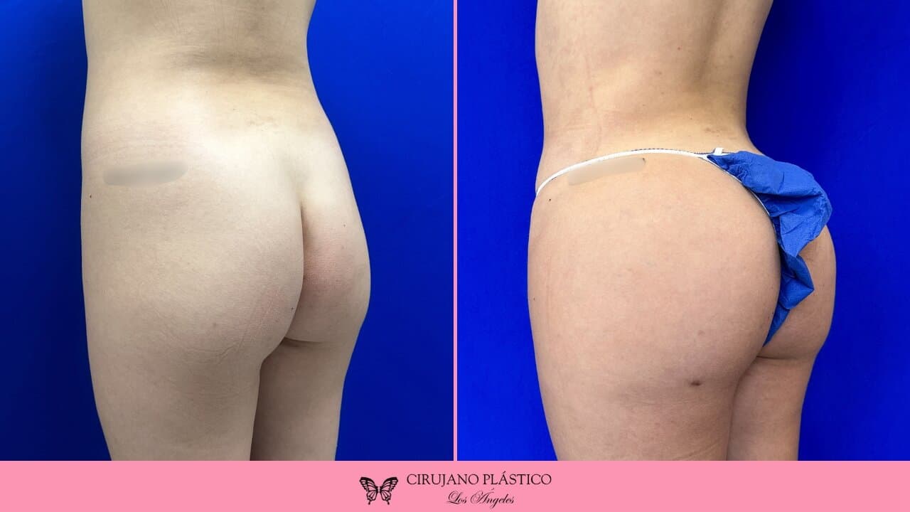 BBL Before and After Patient 5c