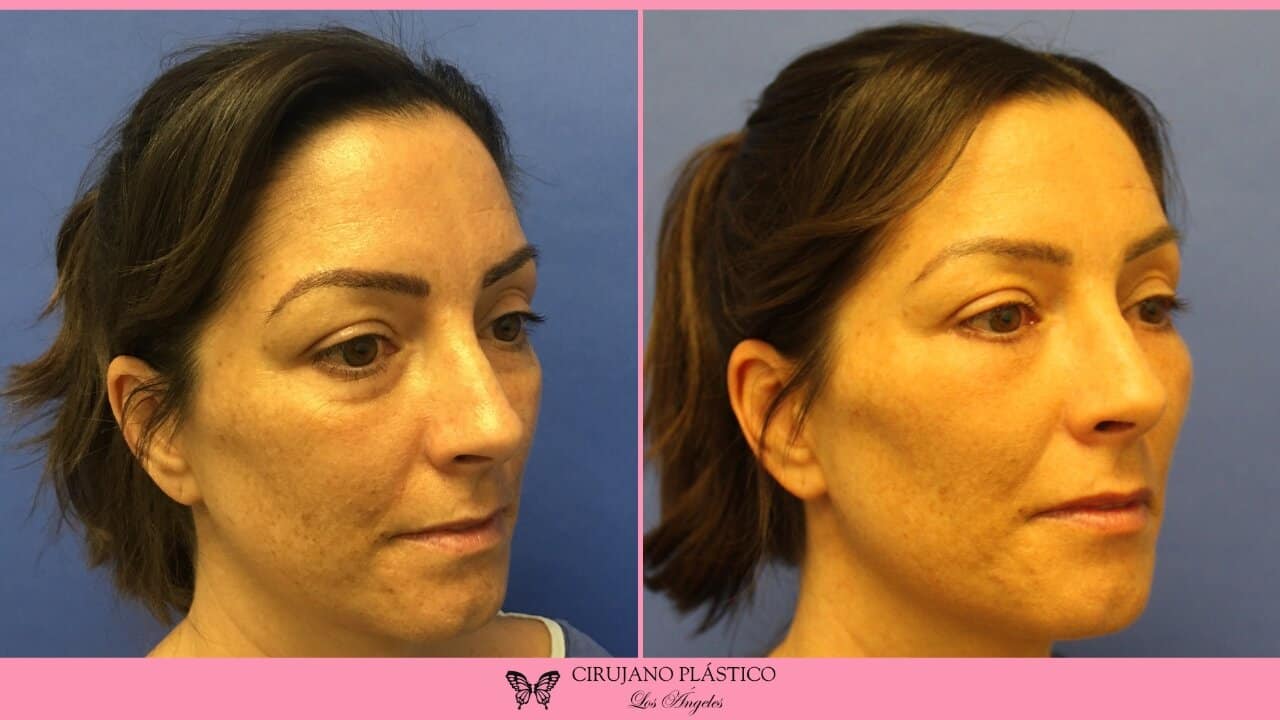 Blepharoplasty Before and After Patient 3b