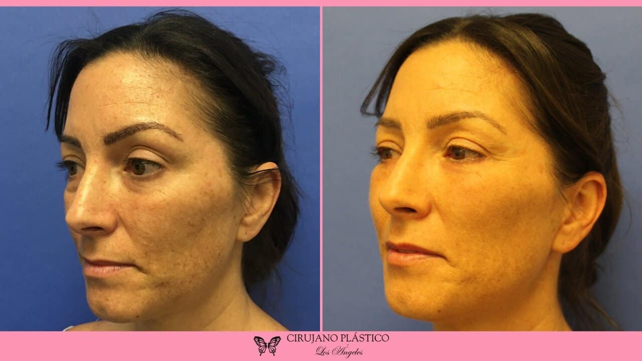 Blepharoplasty Before and After Patient 3c