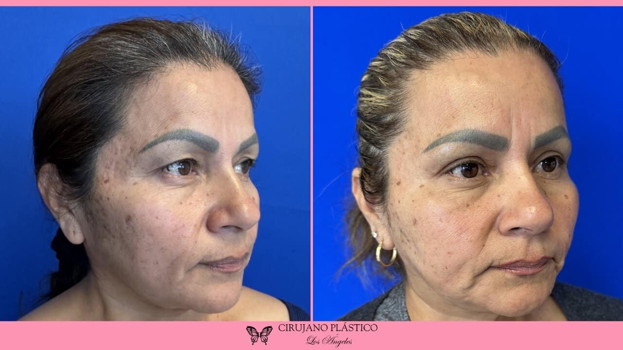 Blepharoplasty Before and After Patient 4b