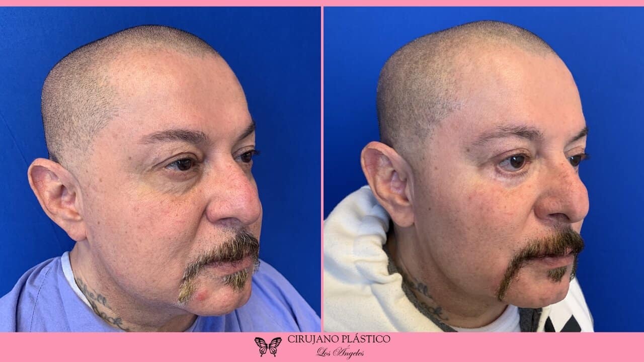 Blepharoplasty Before and After Patient 5b
