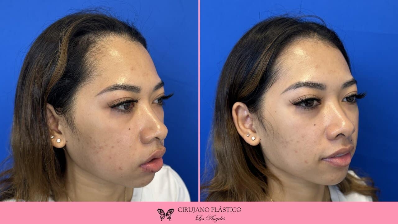 Buccal Fat Removal Before and After Patient 2a