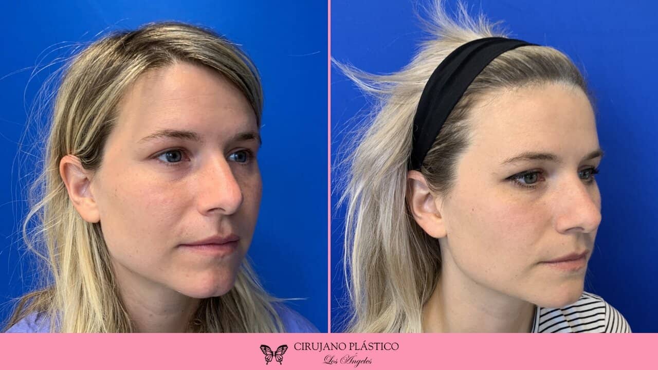 Buccal Fat Removal Before and After Patient 3a