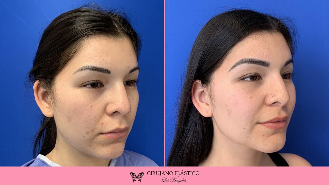 Buccal Fat Removal Before and After Patient 4a