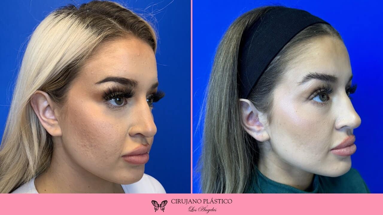 Buccal Fat Removal Before and After Patient 6b