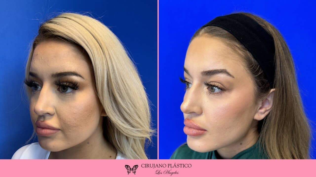 Buccal Fat Removal Before and After Patient 6c