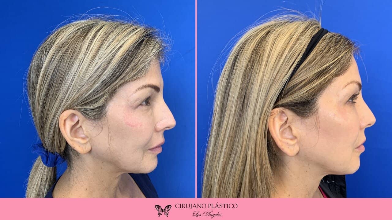 Buccal Fat Removal Before and After Patient 7b