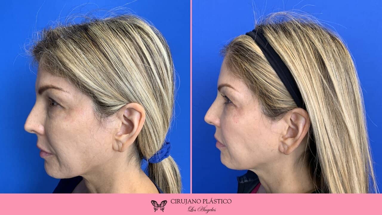 Buccal Fat Removal Before and After Patient 7c