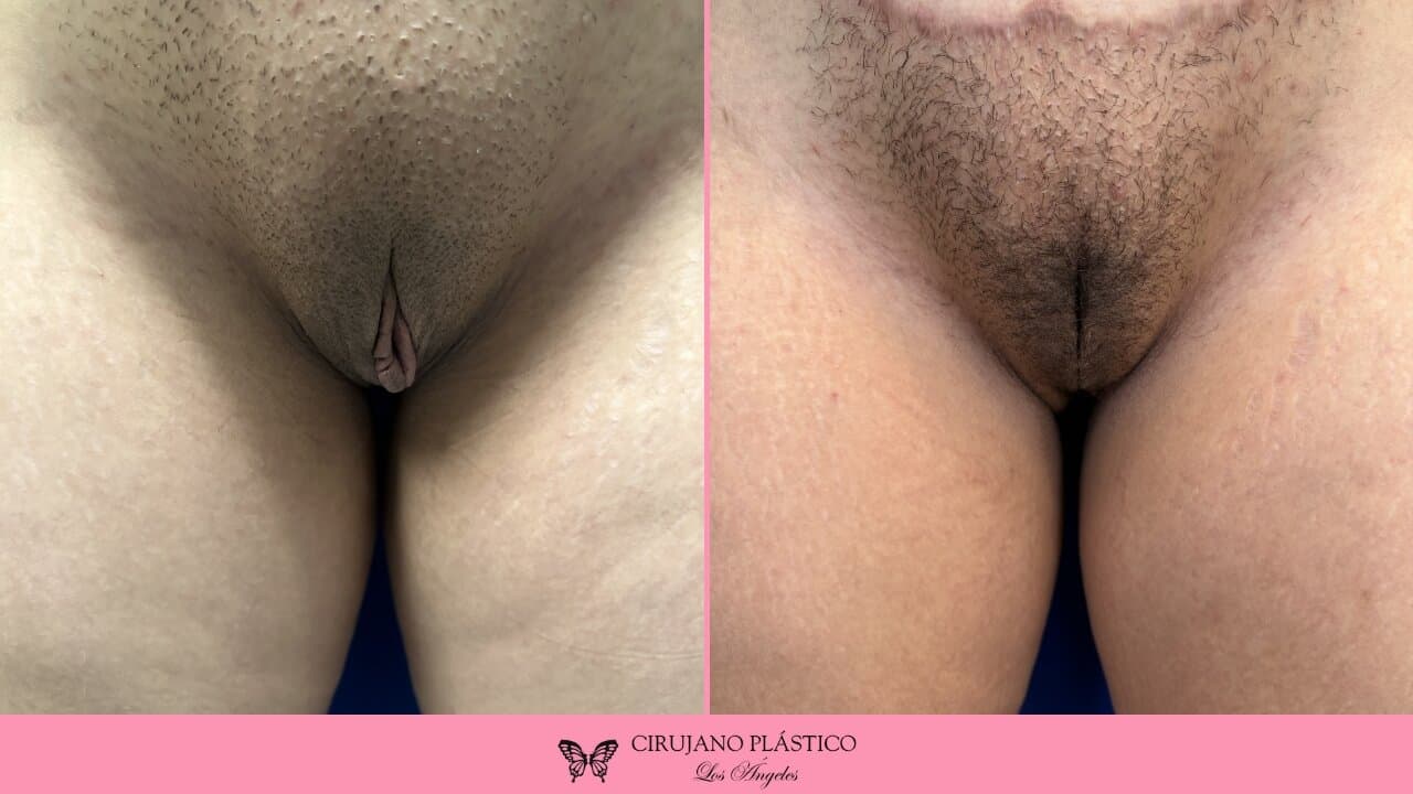 Labiaplasty Before and After Patient 1c