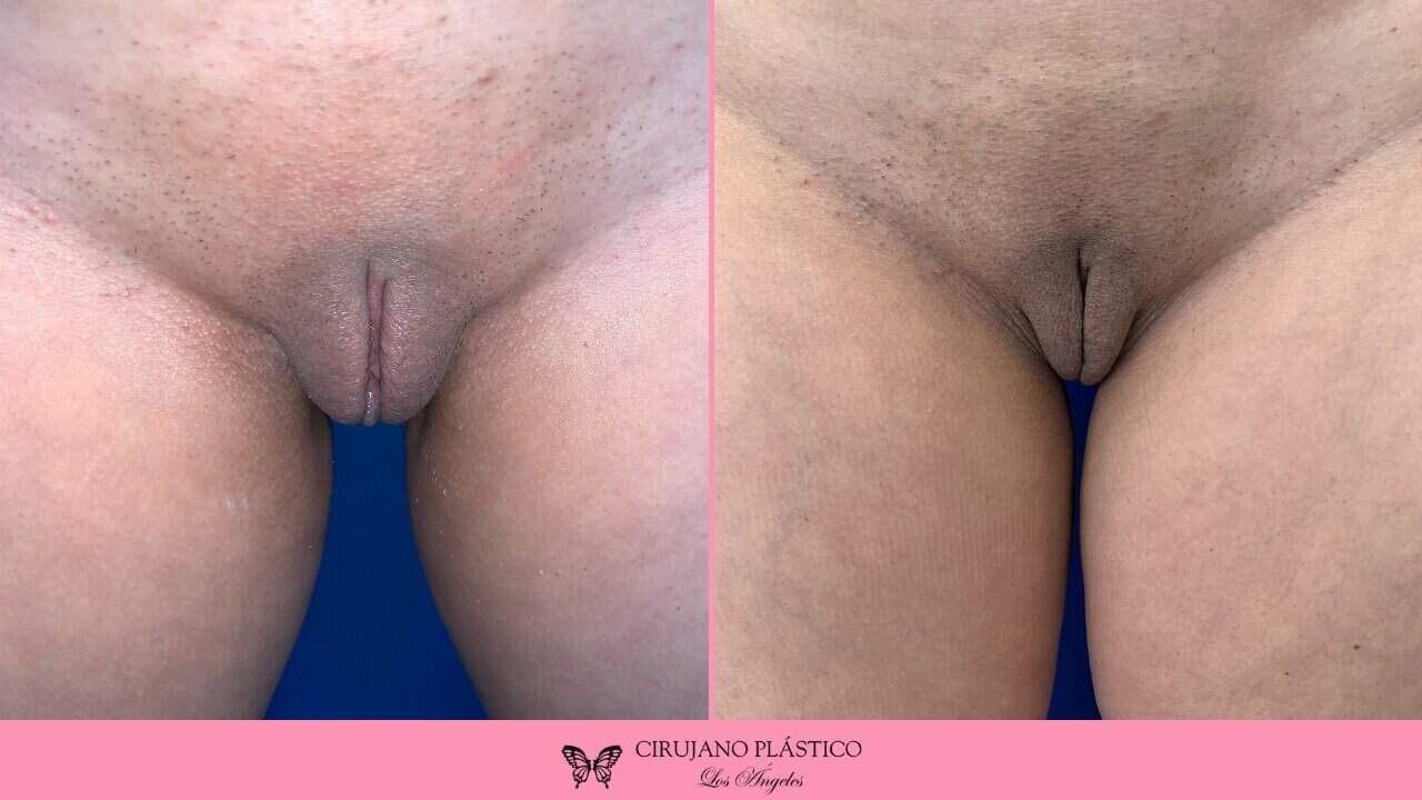 Labiaplasty Before and After Patient 2c