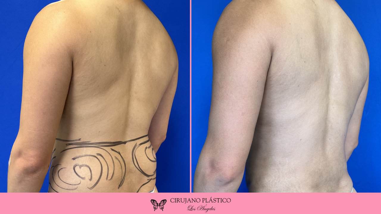 Liposuction Before and After Patient 2c