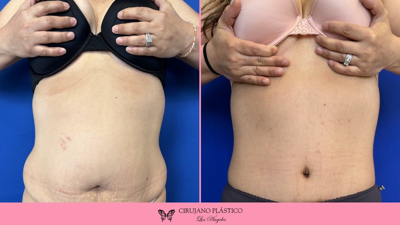 Liposuction Before and After Patient 3a