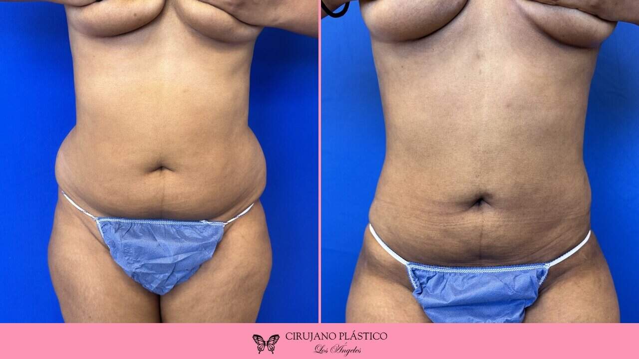 Liposuction Before and After Patient 4a