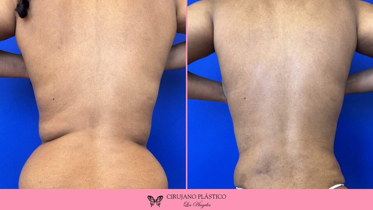 Liposuction Before and After Patient 4b