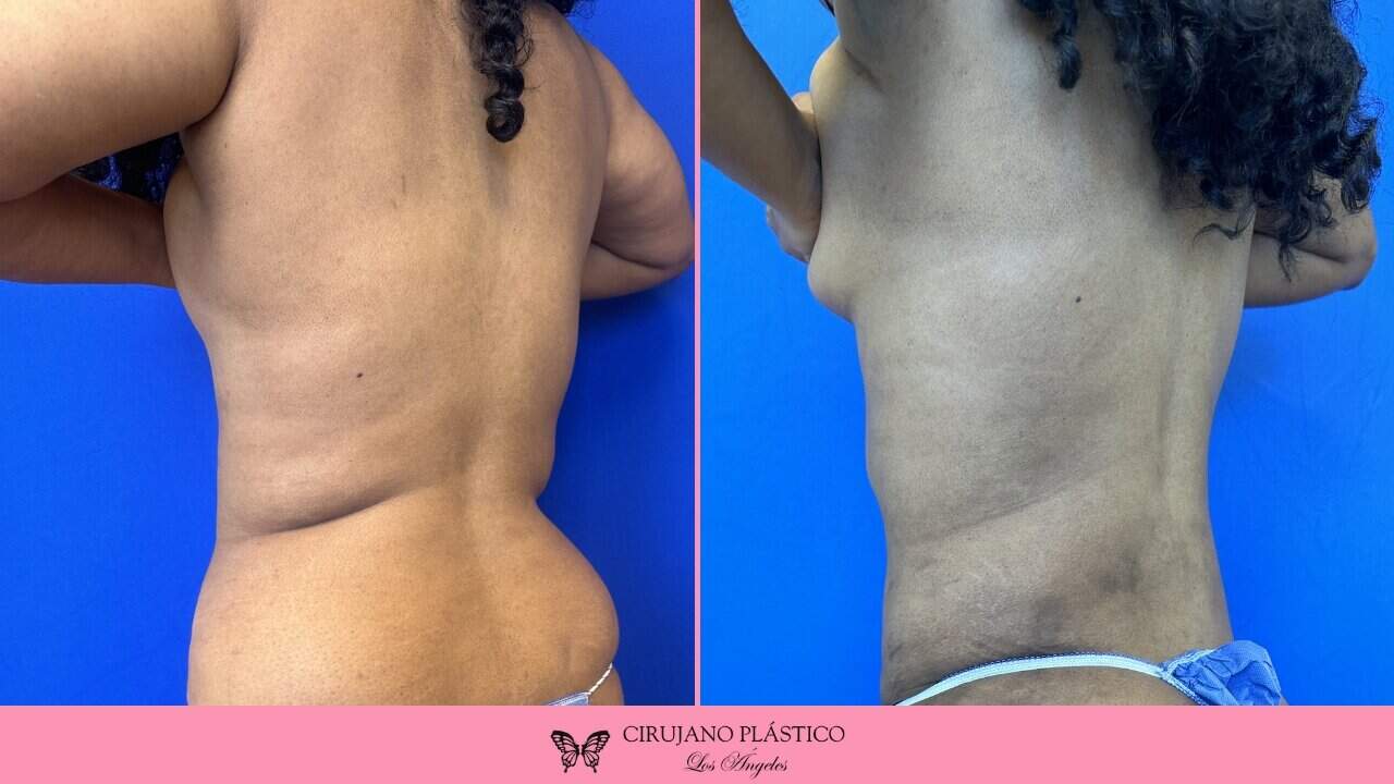 Liposuction Before and After Patient 4c
