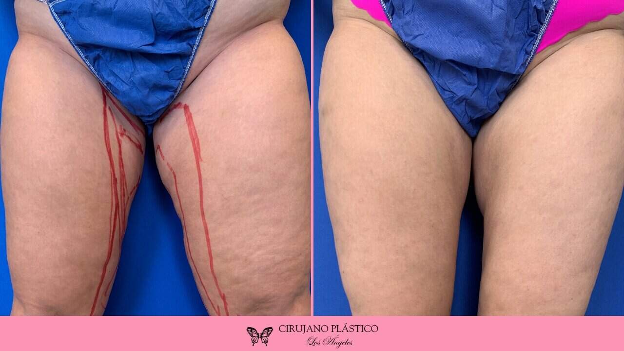 Liposuction Before and After Patient 6a