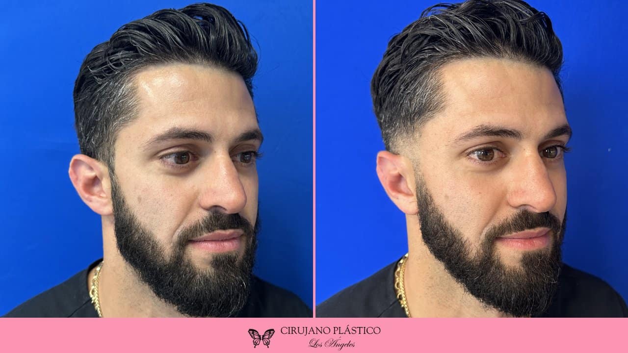 Otoplasty Before and After Patient 1a