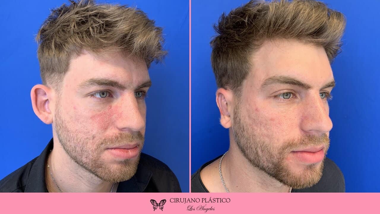 Otoplasty Before and After Patient 2a