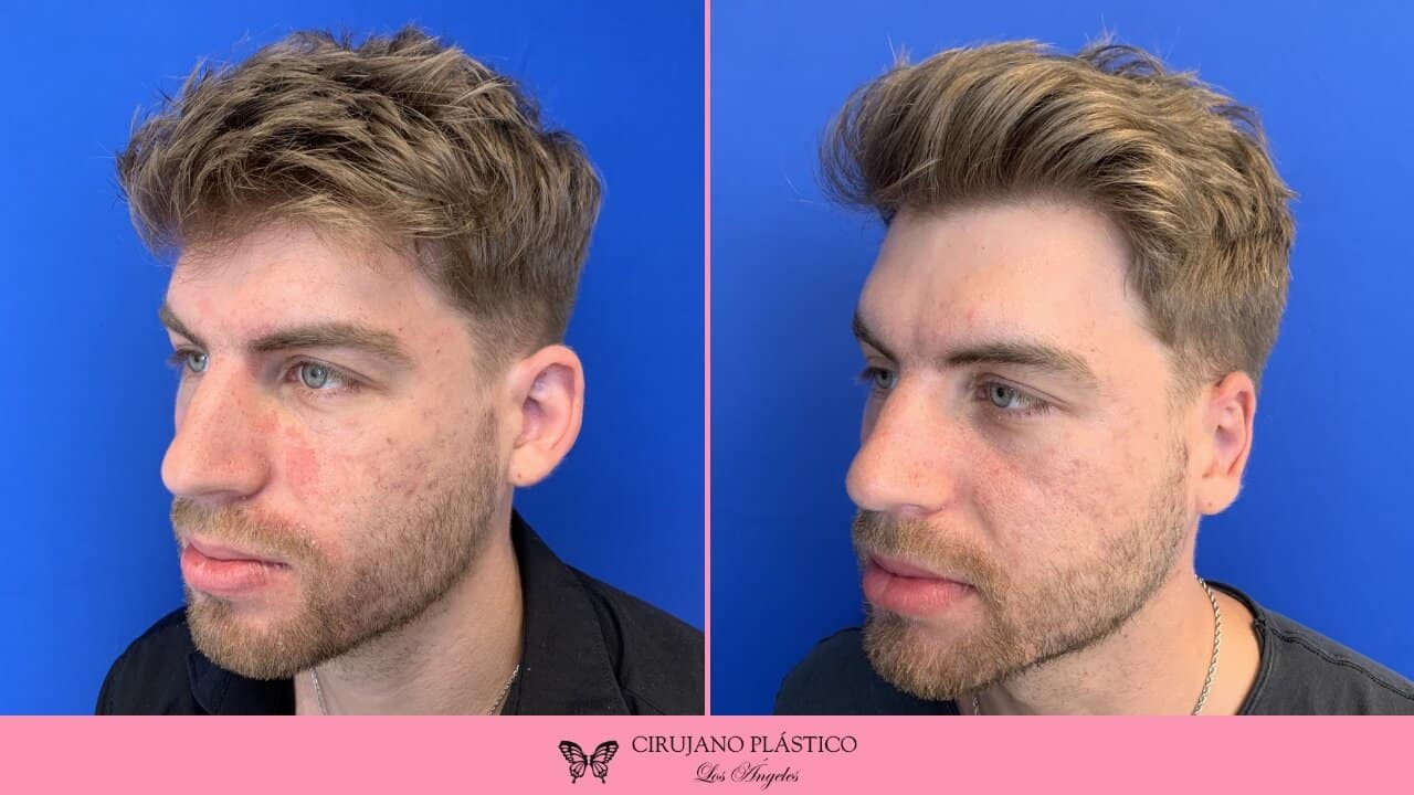 Otoplasty Before and After Patient 2b