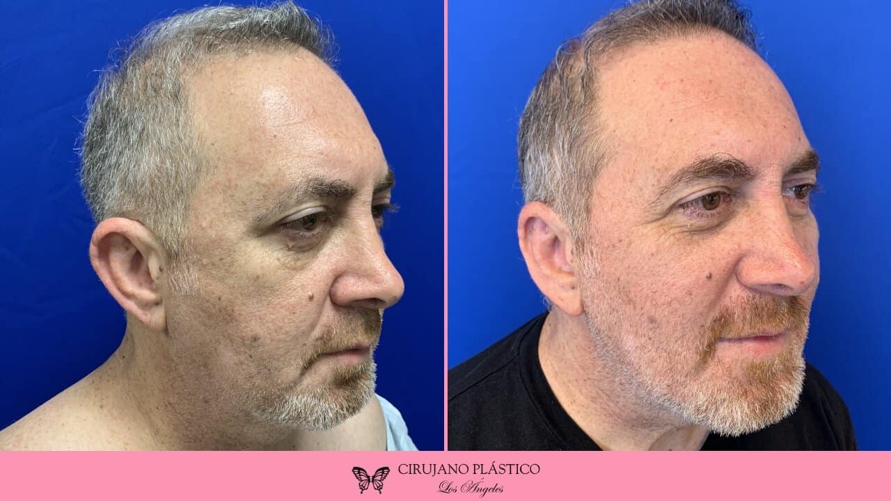 Otoplasty Before and After Patient 3a