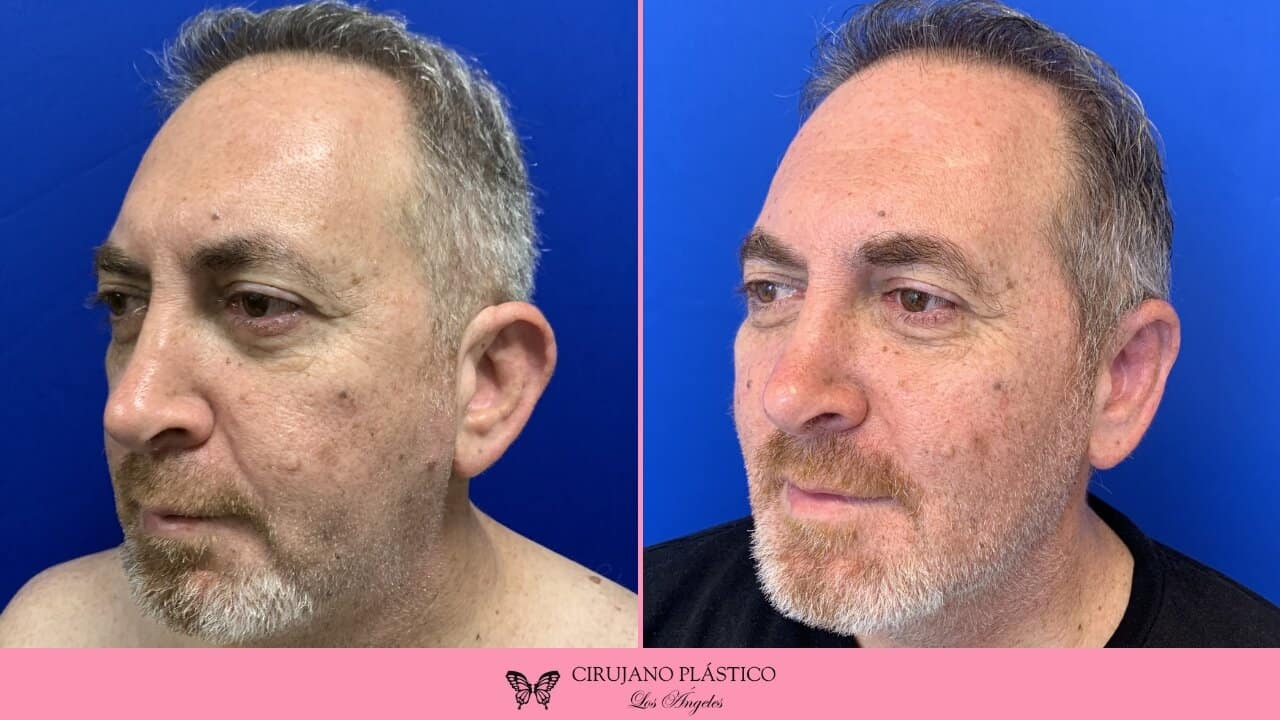 Otoplasty Before and After Patient 3b