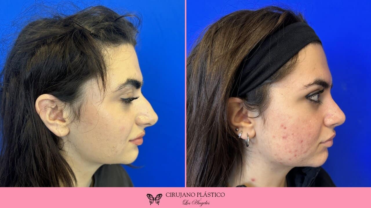 Rhinoplasty Before and After Patient 2b