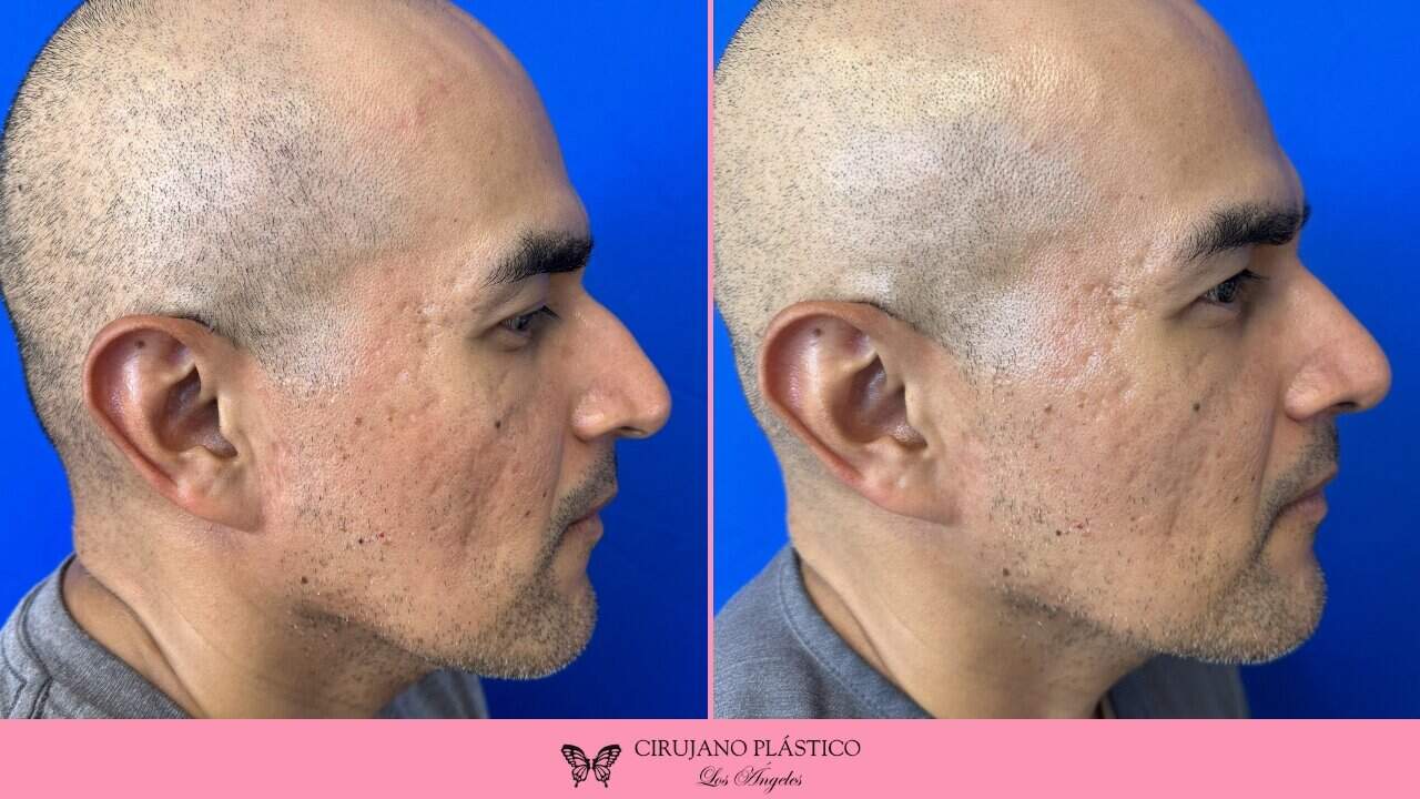 Rhinoplasty Before and After Patient 3a