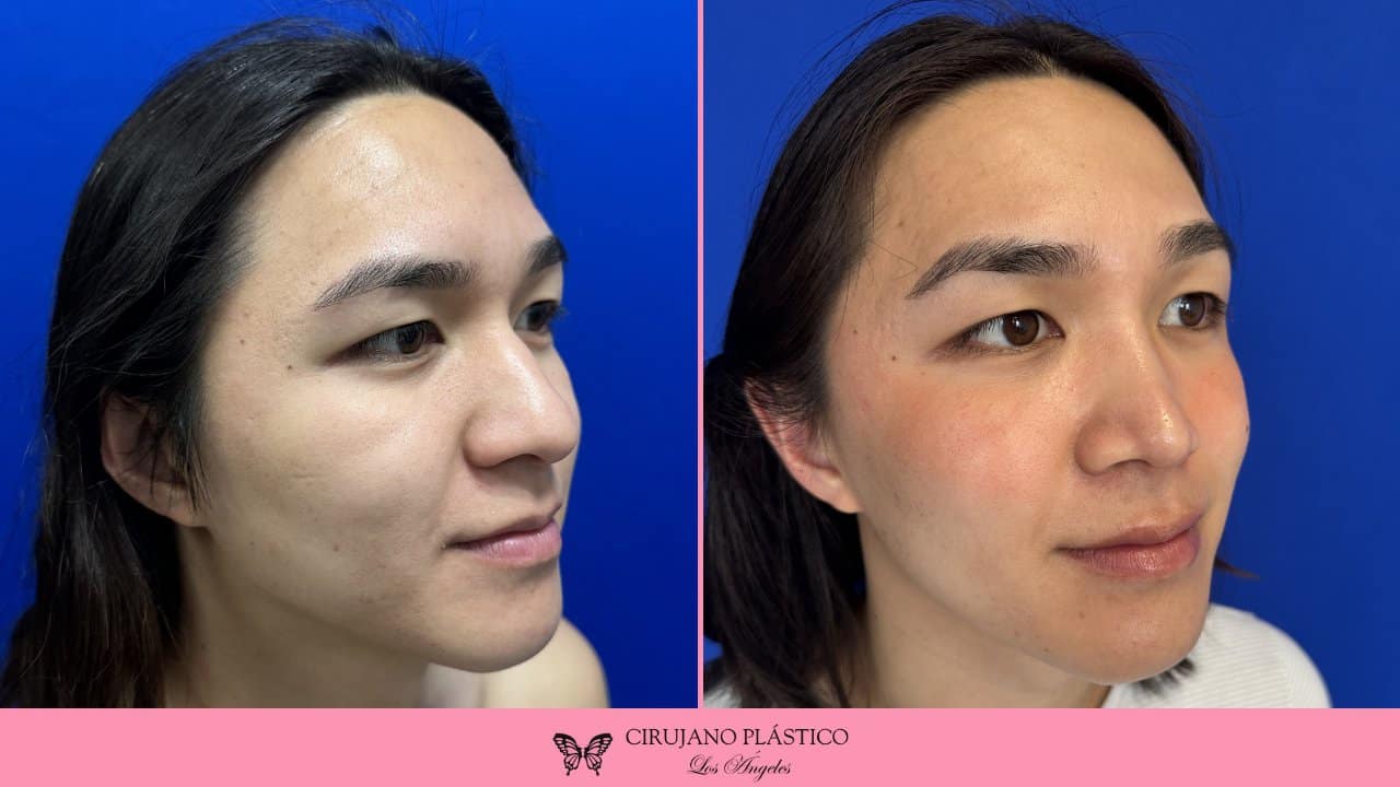 Rhinoplasty Before and After Patient 4b