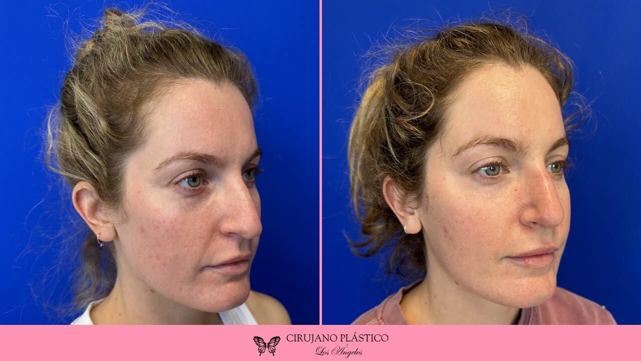 Rhinoplasty Before and After Patient 5b