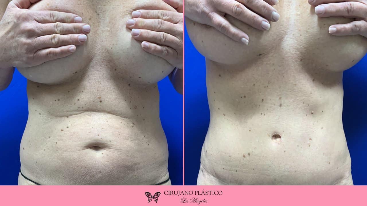 Tummy Tuck Before and After Patient 1a
