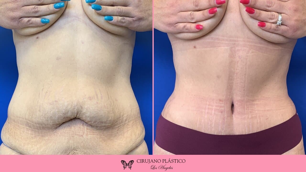 Tummy Tuck Before and After Patient 2a