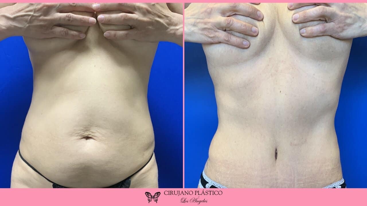 Tummy Tuck Before and After Patient 3a