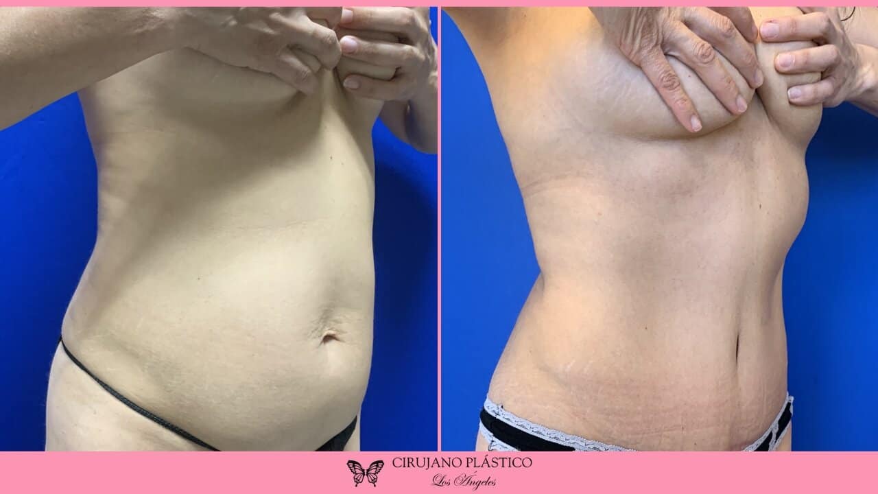 Tummy Tuck Before and After Patient 3b