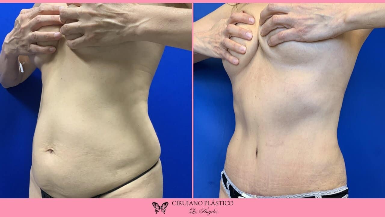 Tummy Tuck Before and After Patient 3c