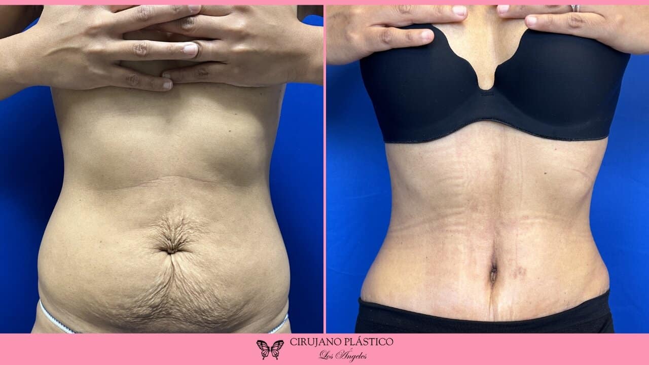 Tummy Tuck Before and After Patient 4a