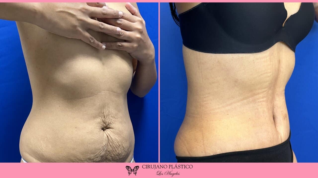 Tummy Tuck Before and After Patient 4b